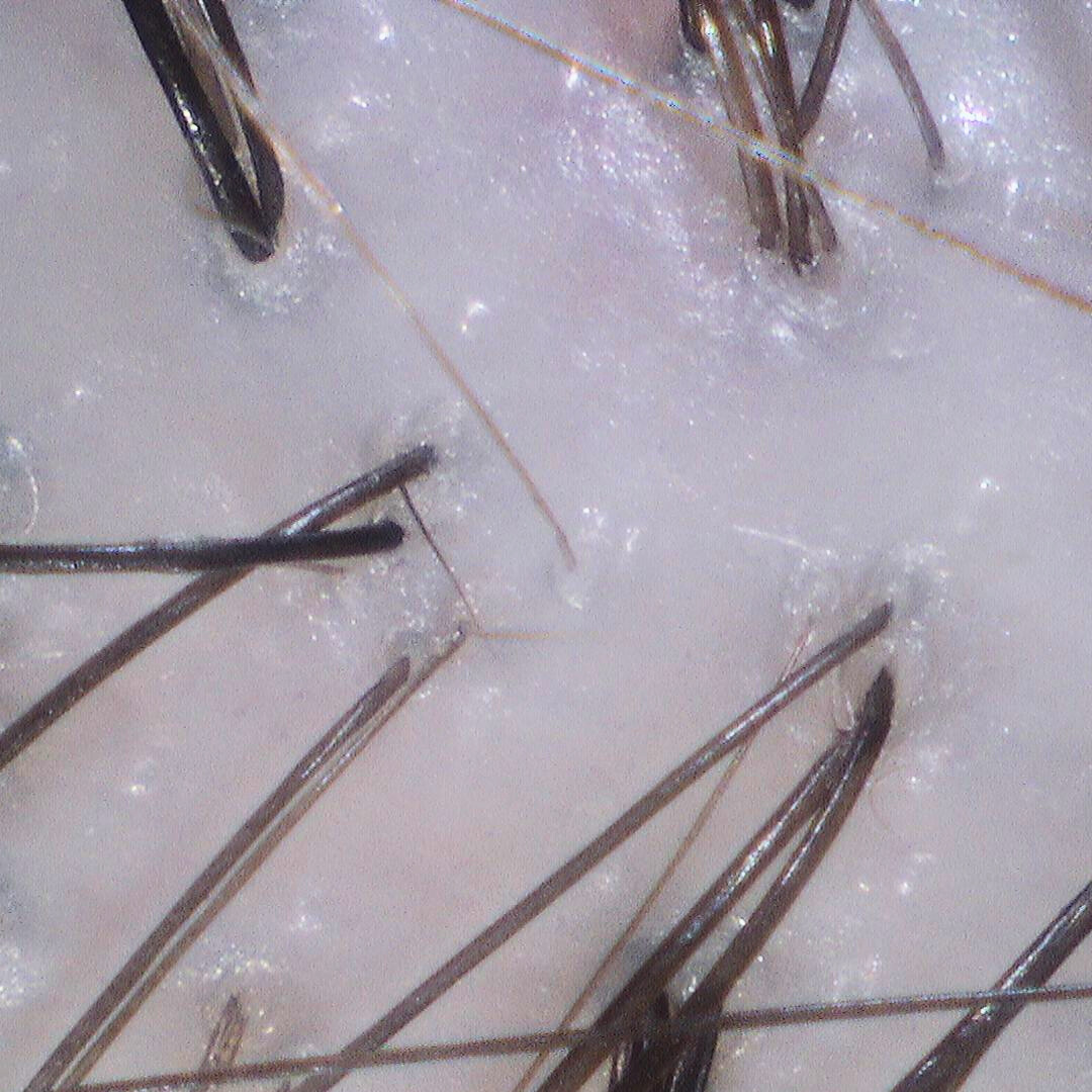 Close-up of clarified scalp with buildup removed after detox scalp treatment