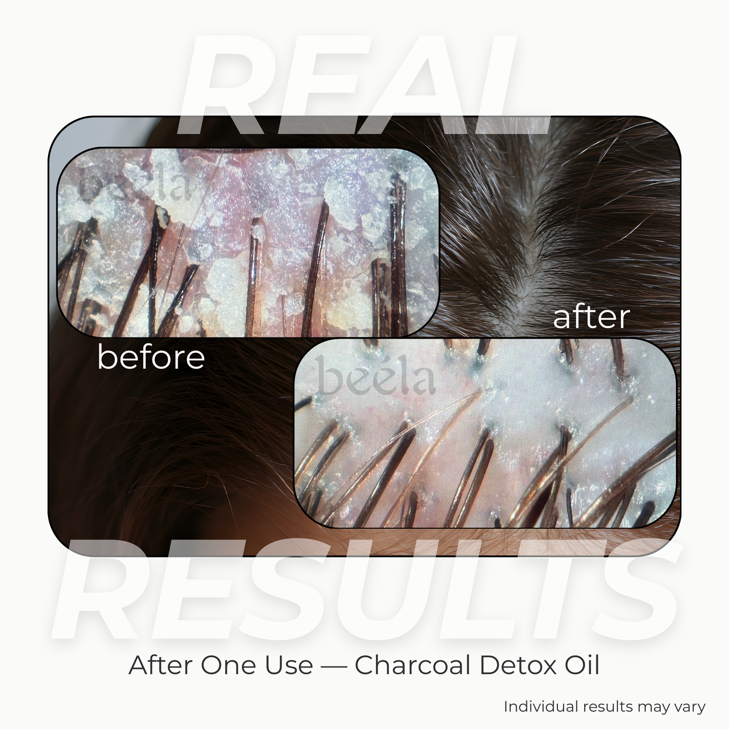 Before and after scalp results after one use of Beela Beautyworks Charcoal Detox Oil, showing reduced buildup and a cleaner-looking scalp.