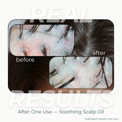 Before and after scalp results after one use of Beela Beautyworks Soothing Scalp Oil, showing a calmer, refreshed-looking scalp.