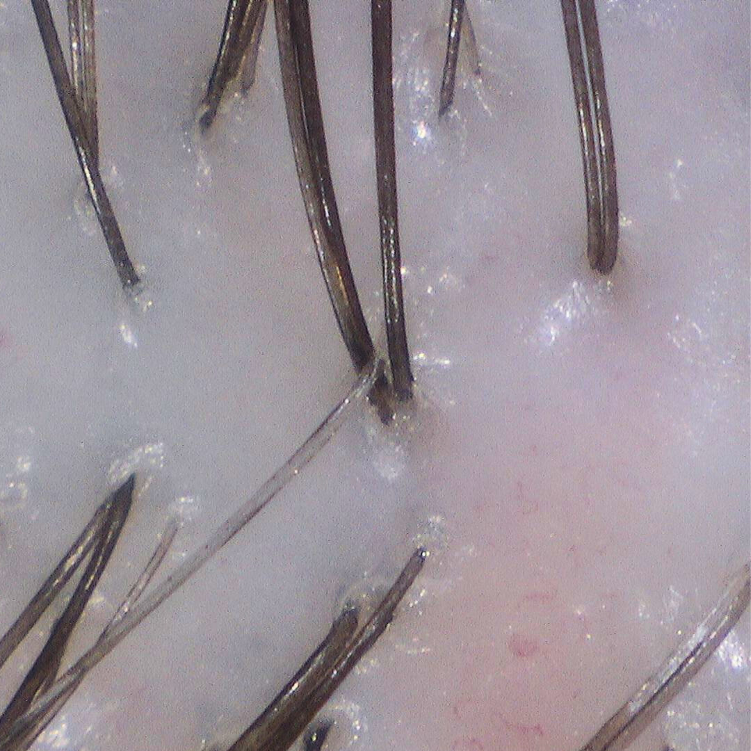 Close-up of clean scalp with clear follicles after detox treatment removing buildup and residue.