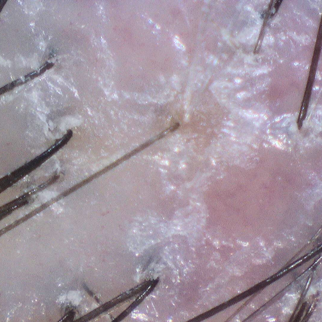 Close-up of dry scalp with visible flakes around hair follicles before hydrate scalp treatment
