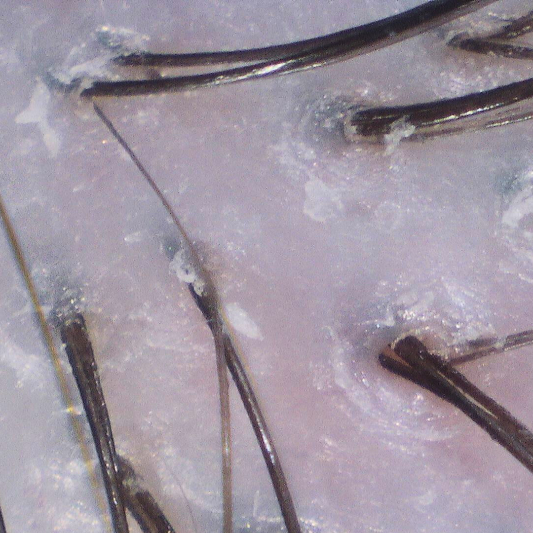 Close-up of very dry scalp with heavy flakes around follicles before hydrate treatment