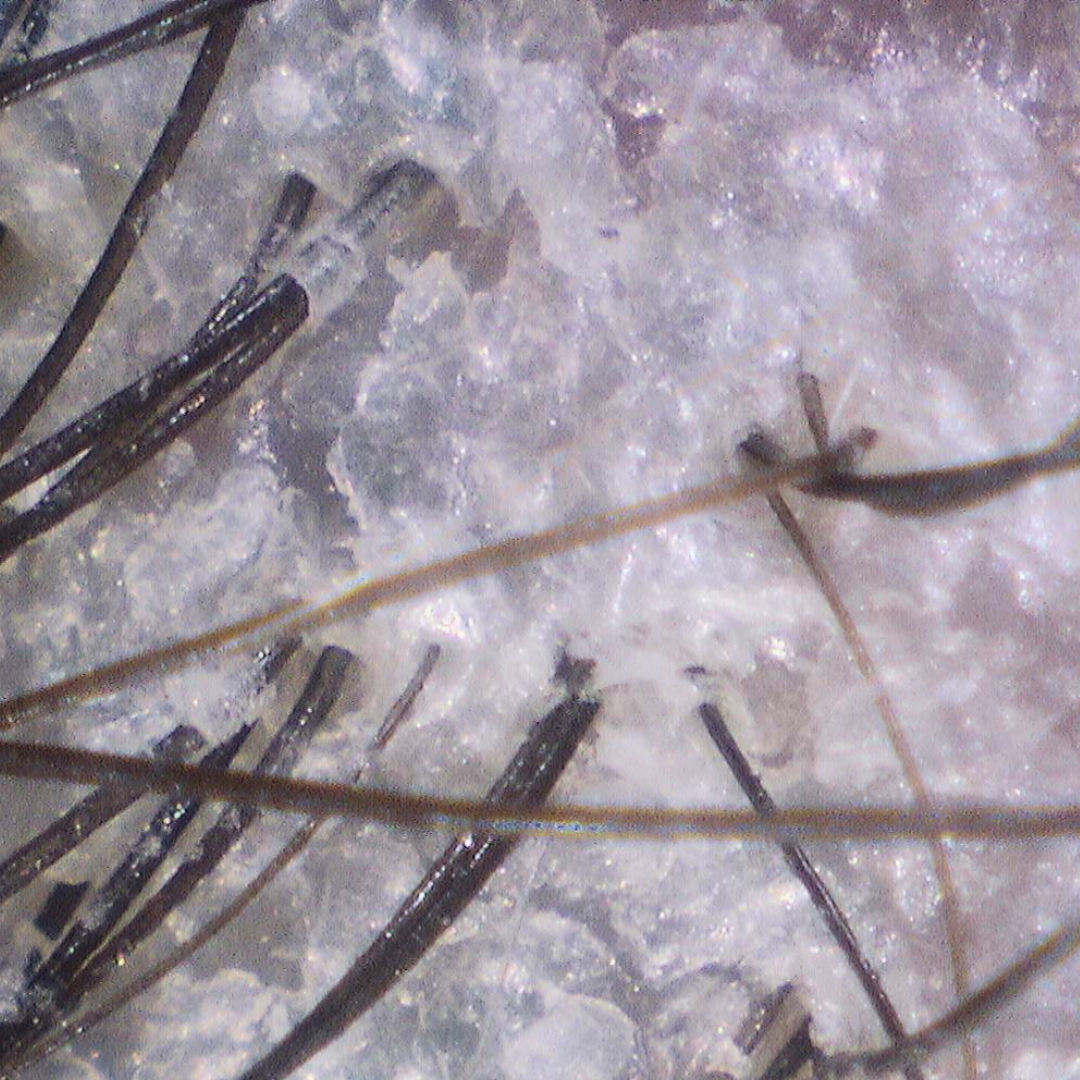 Close-up scalp showing dry skin and flaking around hair follicles before hydrate treatment.