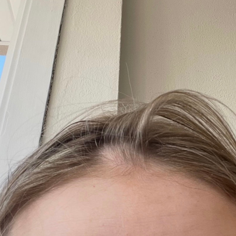 Hair part showing visible thinning and wider part line before hair growth treatment.