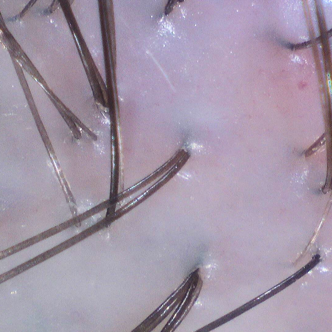 Close-up of hydrated scalp with reduced dryness and flakes after moisturizing scalp treatment