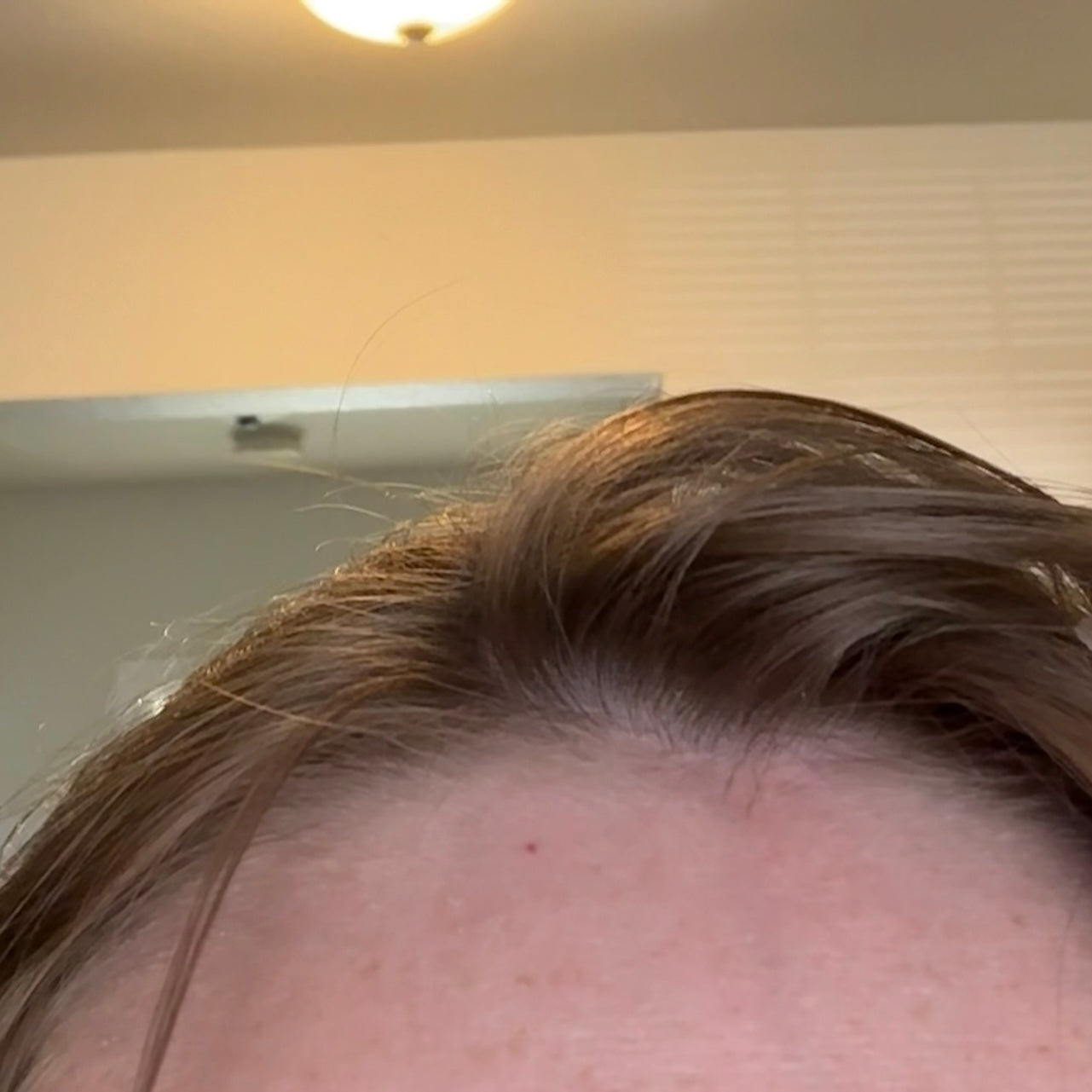 Hair part with improved density and fuller growth after scalp treatment for hair thinning.