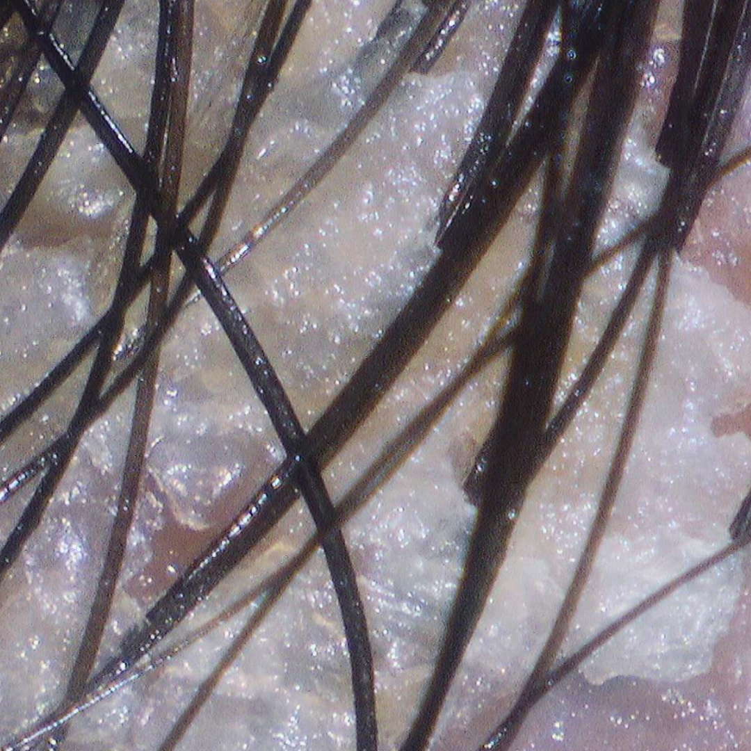 Close-up of irritated dry scalp with visible flaking before hydrate scalp treatment