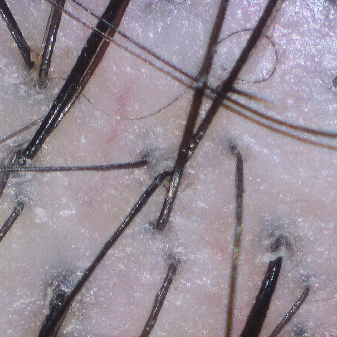 Close-up of scalp with waxy buildup and clogged follicles before detox scalp treatment