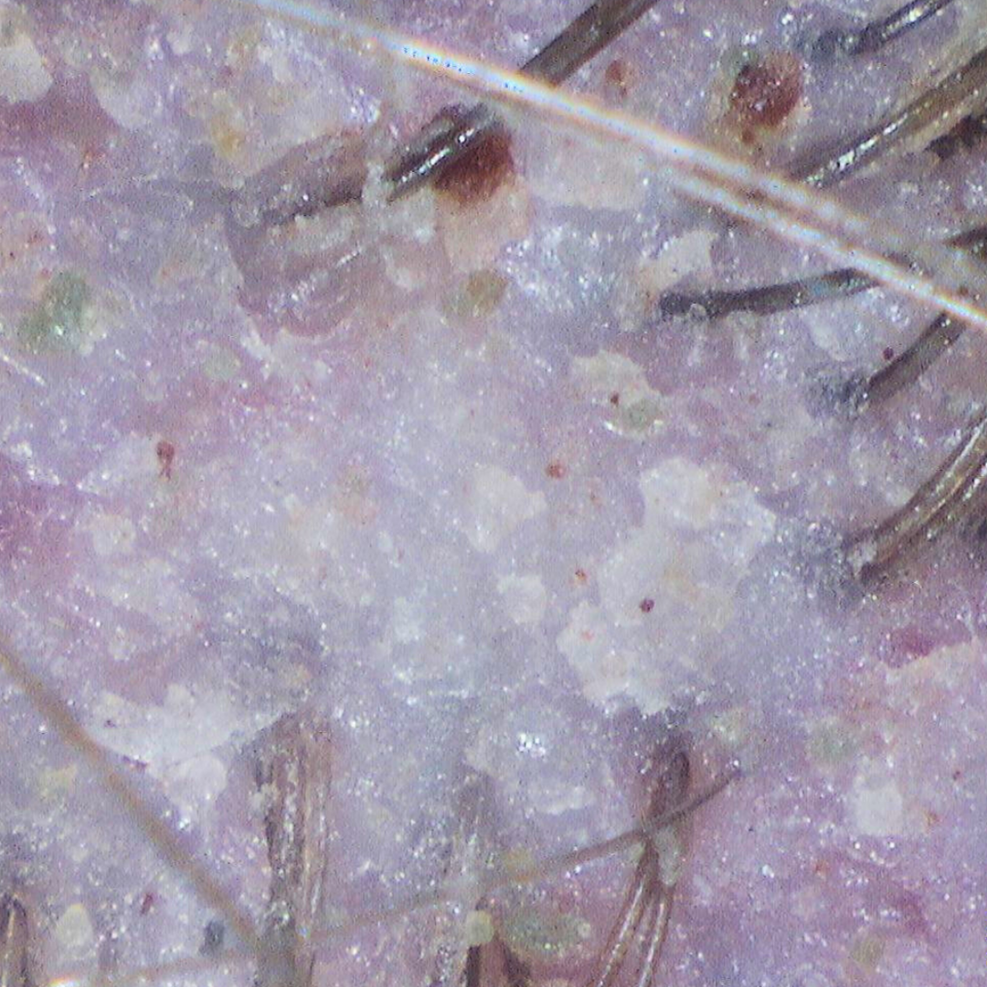 Close-up of scalp with oily buildup and flakes around hair follicles before detox treatment