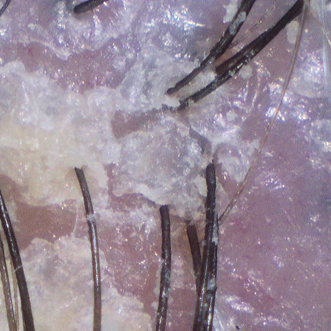 Close-up scalp with heavy product buildup and flakes around hair follicles before detox treatment.